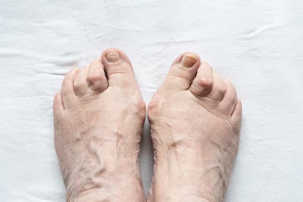 Hammertoe