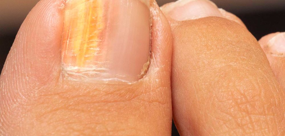 Does Toenail Fungus Ever Go Away on Its Own