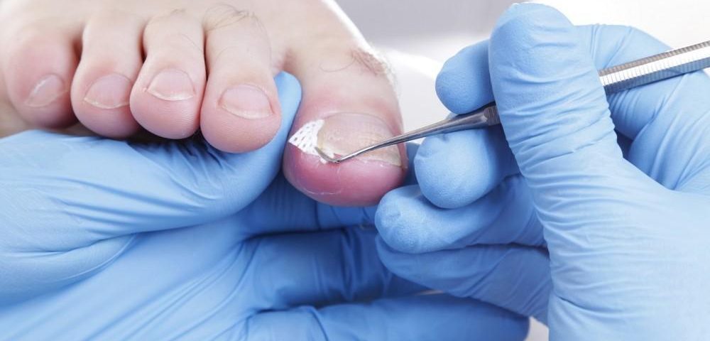Why You Should Never Ignore an Ingrown Toenail With Diabetes