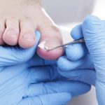 Why You Should Never Ignore an Ingrown Toenail With Diabetes