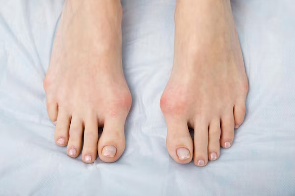 Bunions in Gilbert, Scottsdale, Chandler, Mesa & Phoenix, AZ
