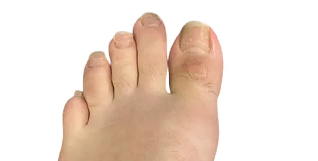 Bunions after