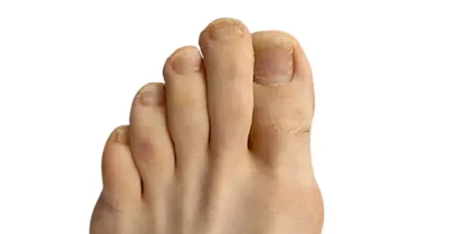 Bunions before