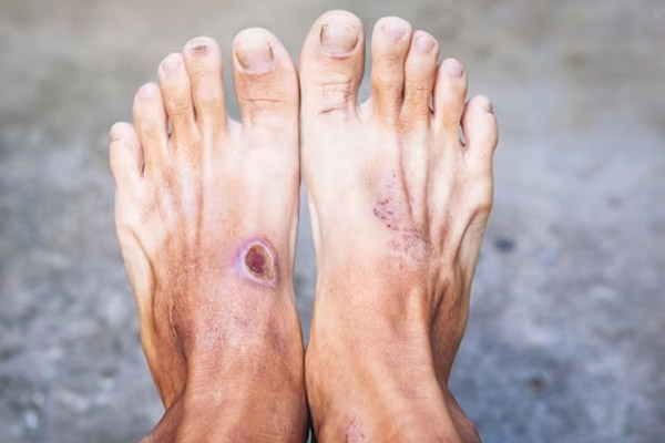 Diabetic Foot Care in Gilbert, Scottsdale, Chandler, Mesa & Phoenix, AZ