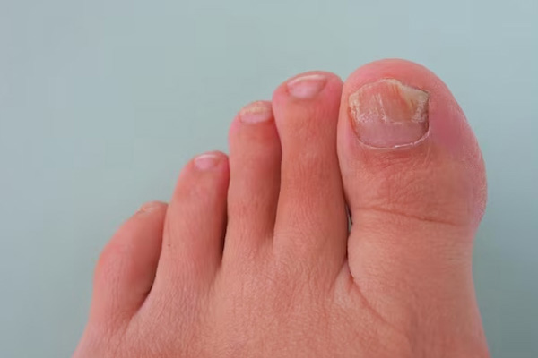 Ingrown Toenails in Gilbert, Scottsdale, Chandler, Mesa & Phoenix, AZ
