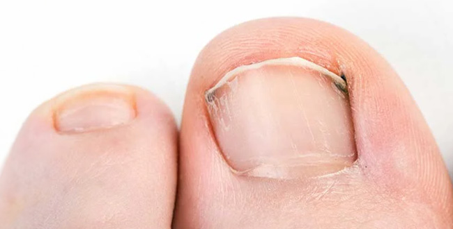 Ingrown Toenails after