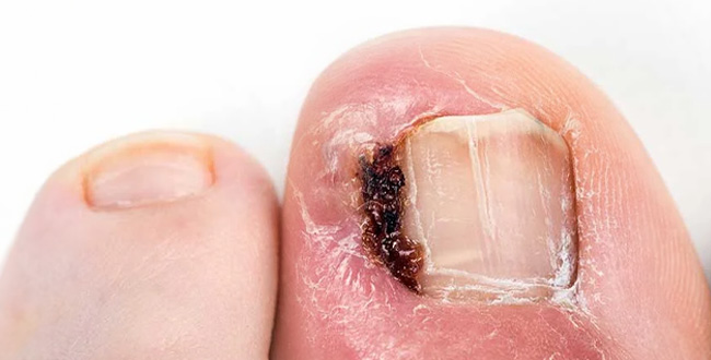 Ingrown Toenails before