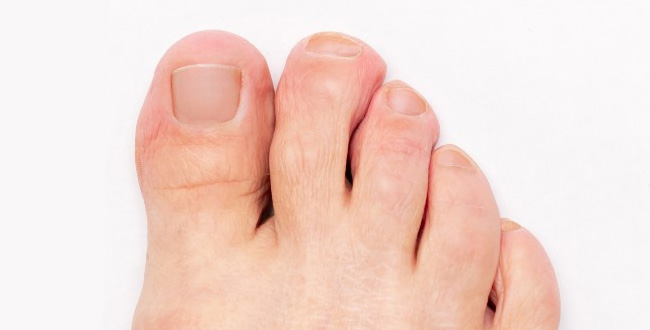 Nail Fungus after
