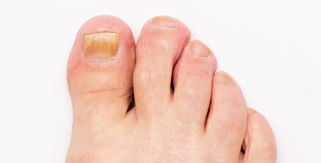 Nail Fungus before