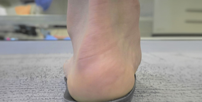 Plantar Fasciitis after