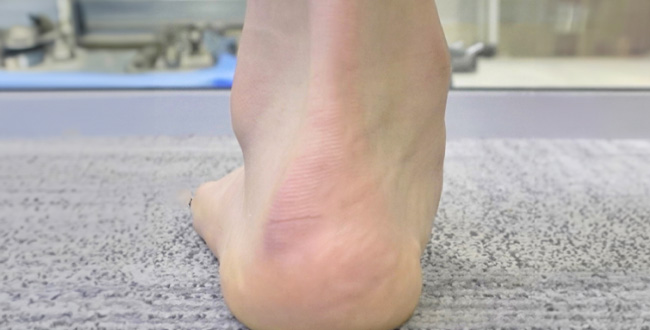Plantar Fasciitis before