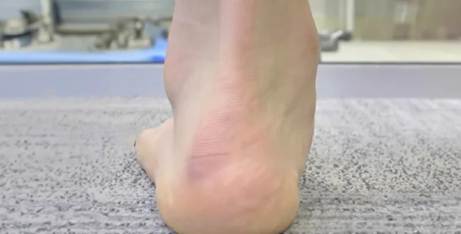 Plantar Fasciitis before