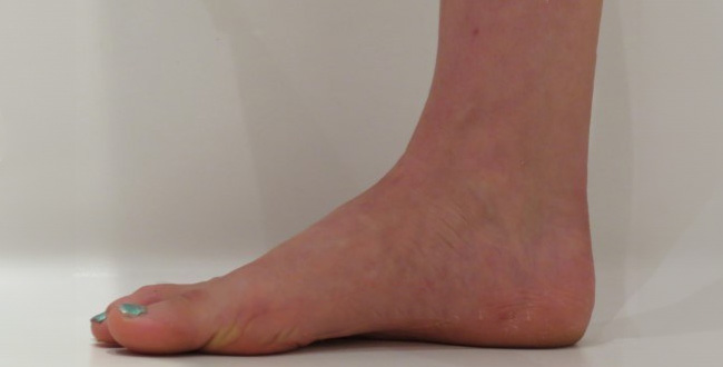 flat feet after