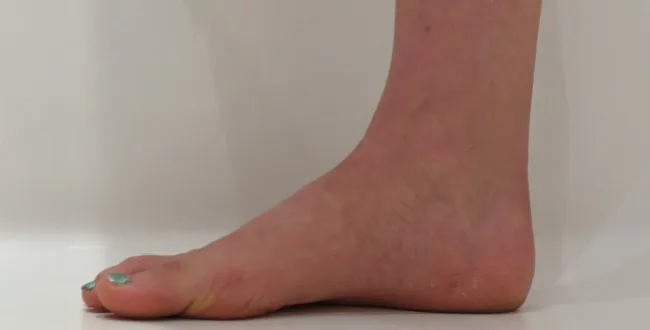 flat feet after