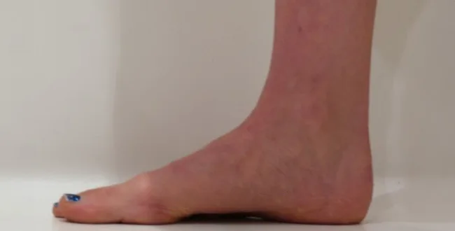 flat feet before