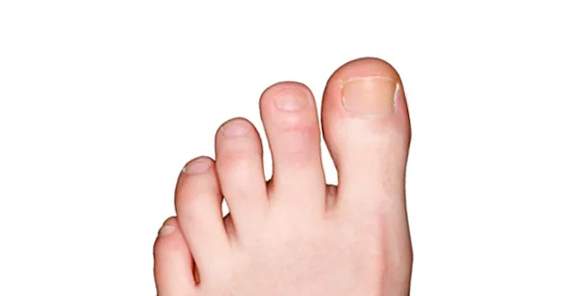 hammertoe after