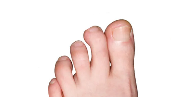 hammertoe before