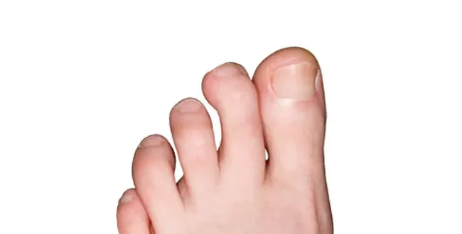 hammertoe before