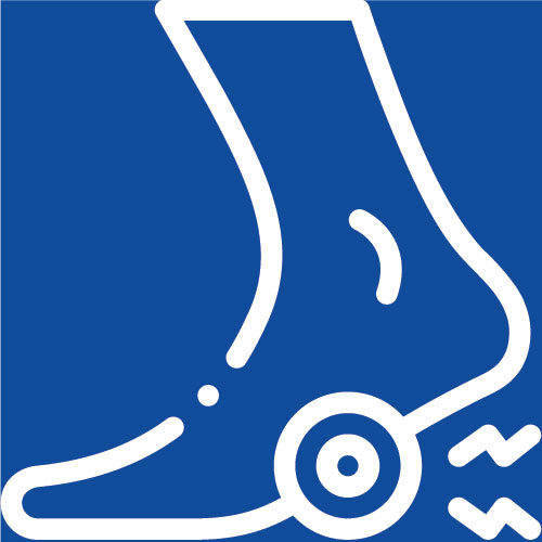 Hammertoe
