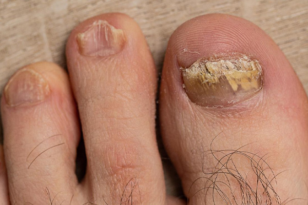Nail Fungus in Gilbert, Scottsdale, Chandler, Mesa & Phoenix, AZ
