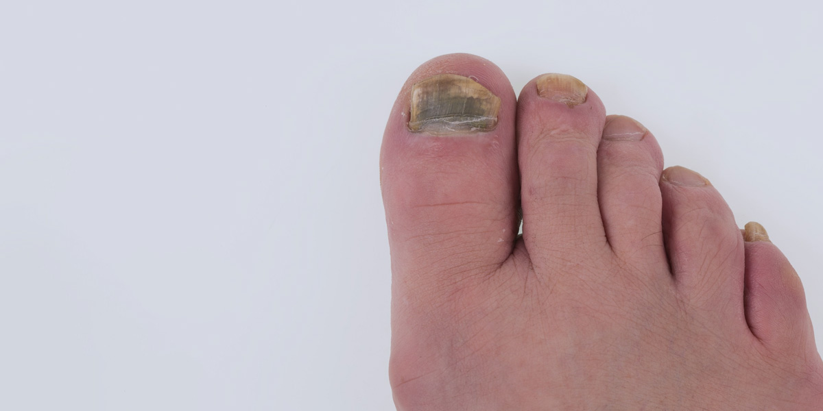 Nail Fungus Treatment in AZ