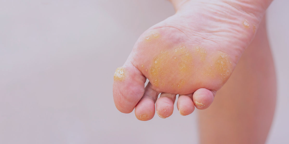 Plantar Warts Treatment in Phoenix, AZ