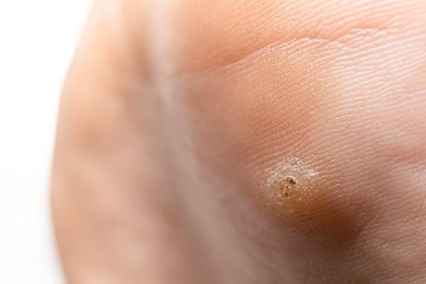 Plantar Warts in Gilbert, Scottsdale, Chandler, Mesa & Phoenix, AZ