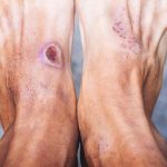Can Diabetic Foot Ulcers Be Cured