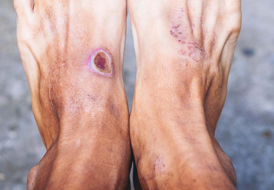 Can Diabetic Foot Ulcers Be Cured