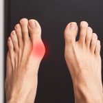 What Are 12 Exercises for Bunions