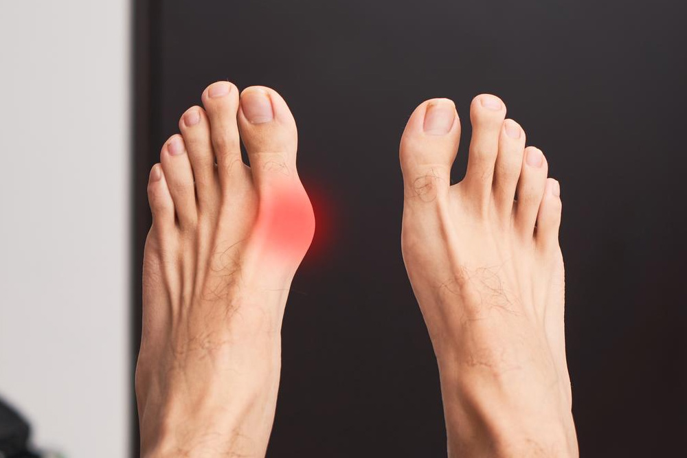 12 Exercises Good for Relieving Bunion Pain