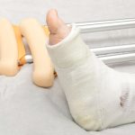 Ankle Fracture Open Reduction and Internal Fixation Surgery in Arizona