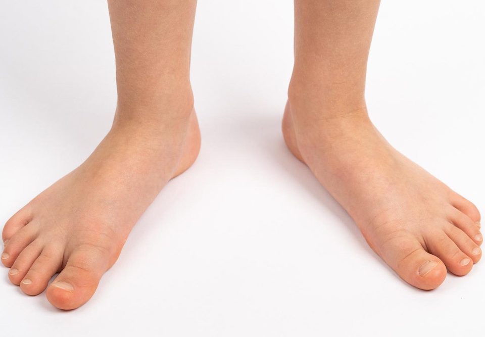 Foot Surgery for Flatfeet Recovery, Procedure, Cost