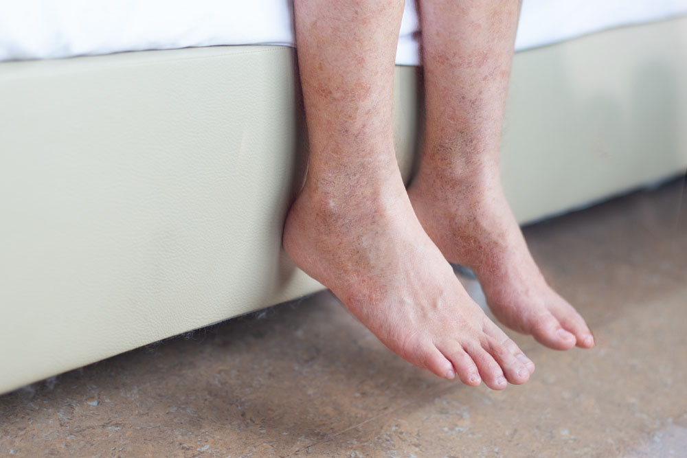 Treatments and Causes of Discoloration on Feet and Ankles