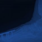 Metatarsophalangeal Joint Fusion Surgery