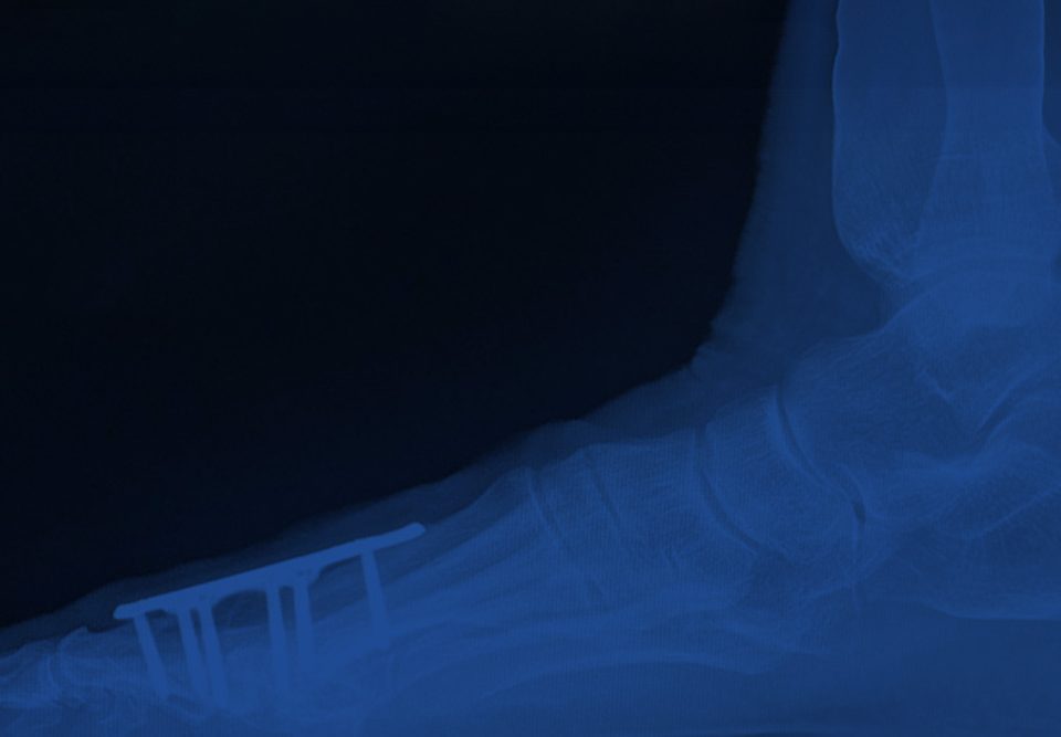 Metatarsophalangeal Joint Fusion Surgery