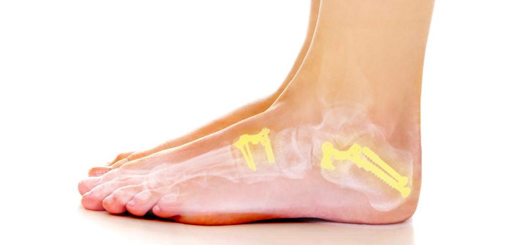 Process and Recovery from Midfoot Fusion Surgery