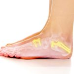 Process and Recovery from Midfoot Fusion Surgery