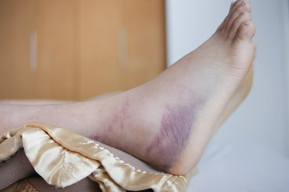 What Does Discoloration of the Ankles and Feet Mean?