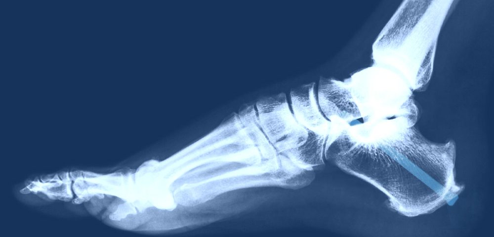 Ankle Fusion Surgery Procedure, Recovery, Cost