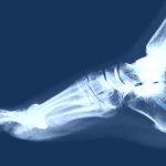 Ankle Fusion Surgery Procedure, Recovery, Cost