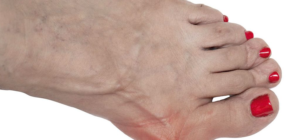 Gout vs. Bunion Symptoms, Differences and Treatment