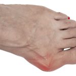 Gout vs. Bunion Symptoms, Differences and Treatment