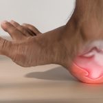 Plantar Fasciitis Rupture Symptoms, Treatments and More