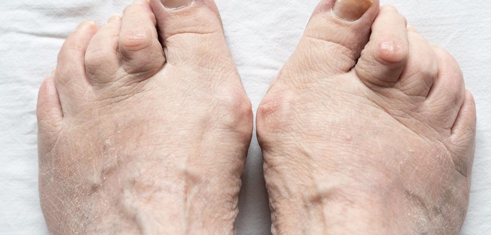 Recovery from Hammertoe Surgery What to Expect
