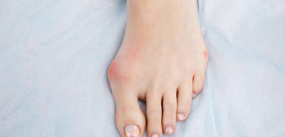 What are the Long-Term Problems You Can Have Years After Bunion Surgery