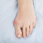 What are the Long-Term Problems You Can Have Years After Bunion Surgery
