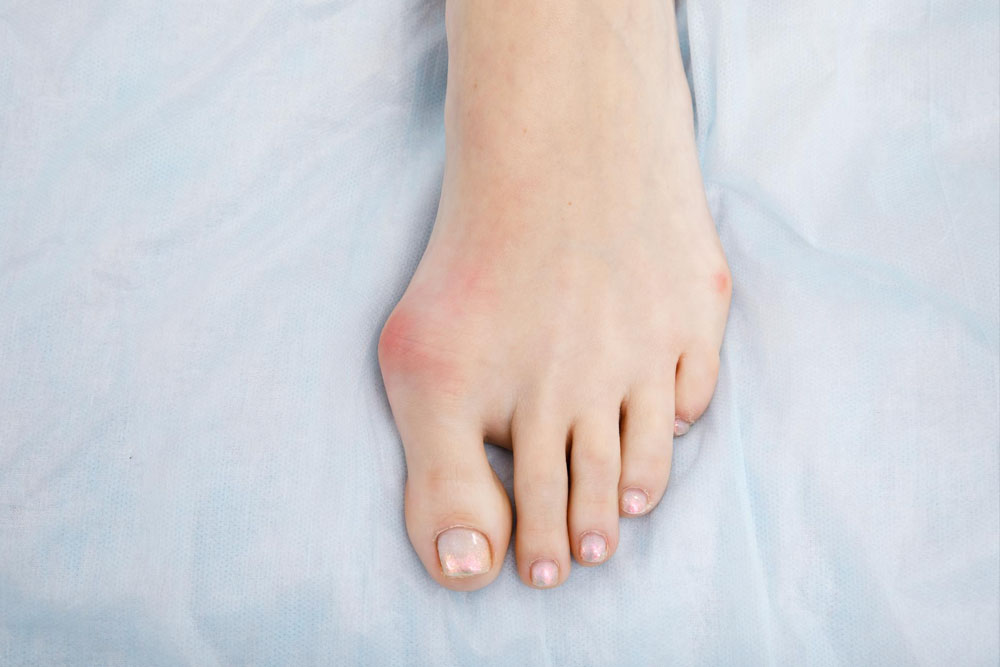 The Long Term Problems after Bunion Surgery Fotankleaz