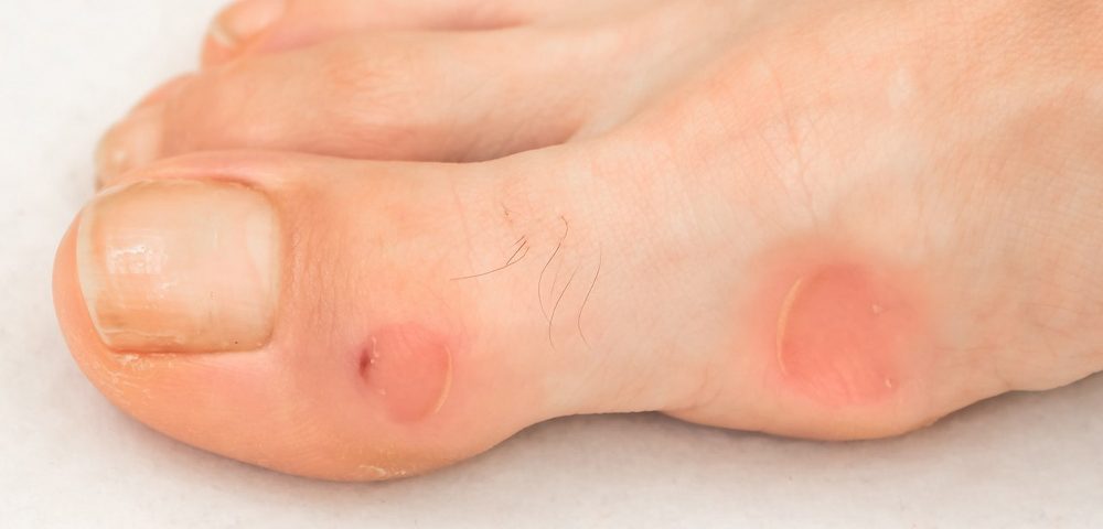 What is the Difference Between Corn, Callus, and Bunion