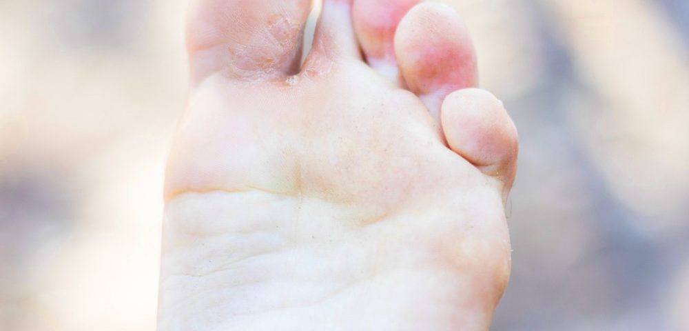 Does Lysol Kill an Athlete's Foot